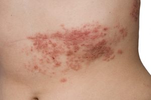 Shingles: A Ghost of Chickenpox Past
